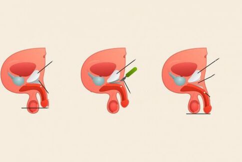 avant et après la chirurgie d'agrandissement du pénis